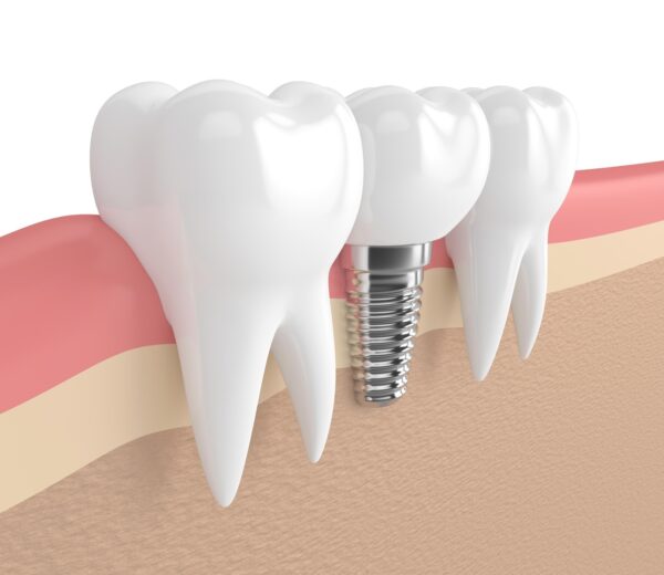 dental-Implant.jpg