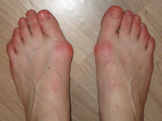 Exploring 5 Trending Devices for your Bunions